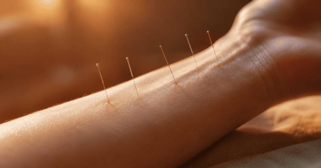 Acupuncture needles on wrist for stress relief