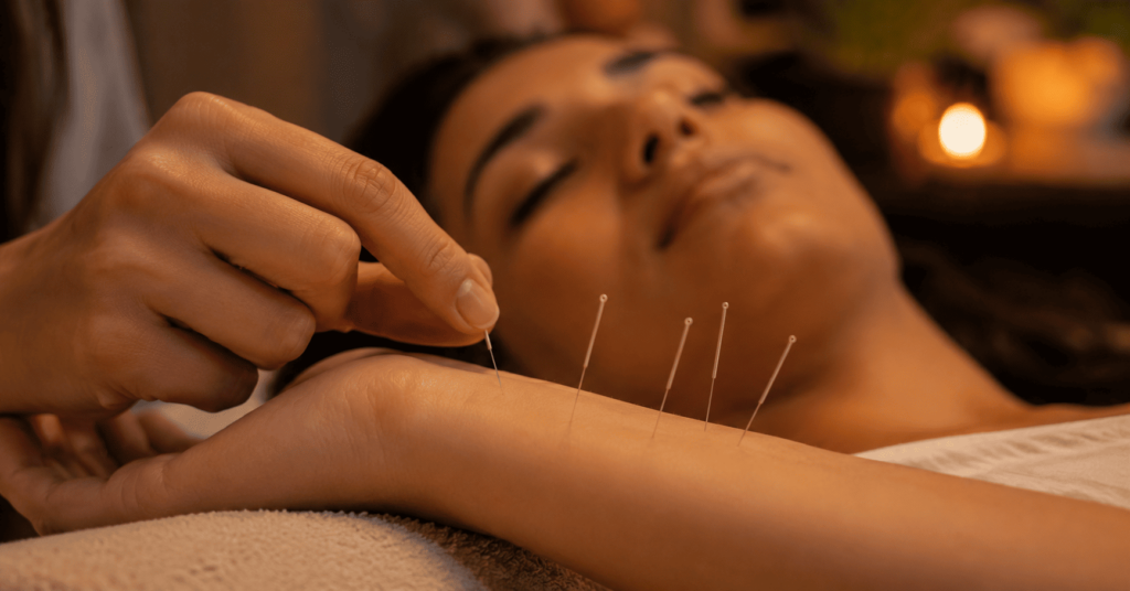  Acupuncture needles at Shenmen wrist point for insomnia