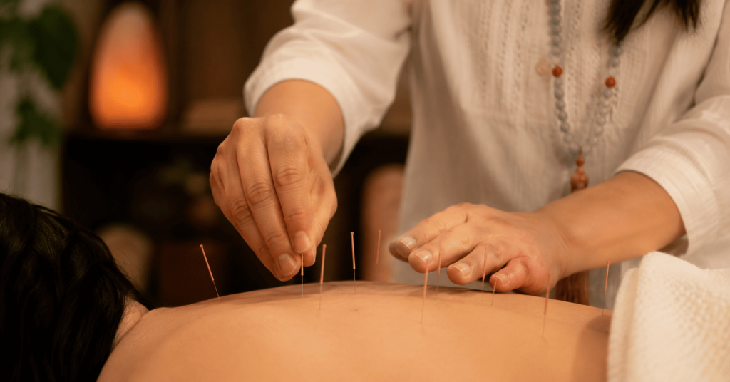 acupuncture needles placed by licensed acupuncturist